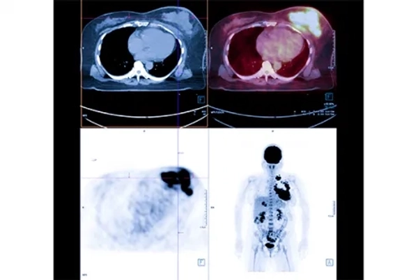 Lutetium Therapy in Neuroendocrine Tumors